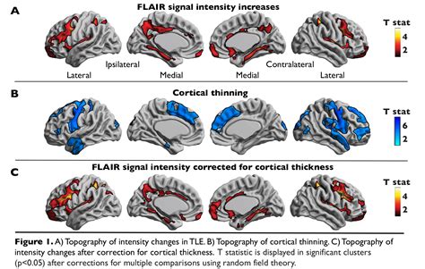 Whole Brain Mapping Of Gliosis In Temporal Lobe Epilepsy Using Flair