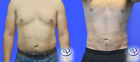 Liposuction For Men Aydin Center For Plastic Surgery