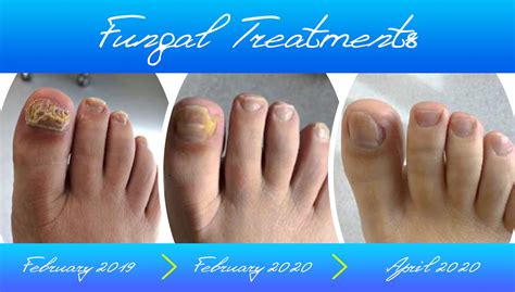 Fungal Nail Infection Treatments Cotgrave Rushcliffe Nottinghamshire