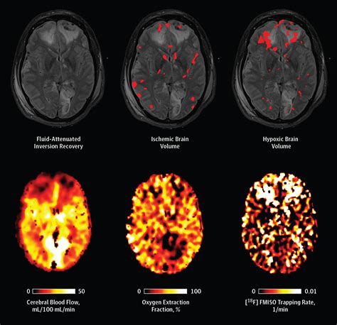 Cerebral Ischemia And Diffusion Hypoxia In Traumatic Brain Injury