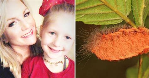 5 Year Old Hospitalized After Sting From Most Poisonous Caterpillar