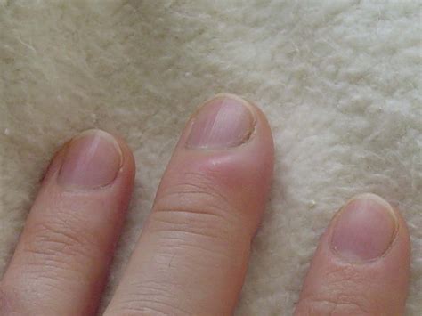 Treatment Of Fingernail Fungus General Center