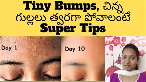 3 Days Challenge💕 Get Rid Of Tiny Bumps Naturally In Just 3 Days And