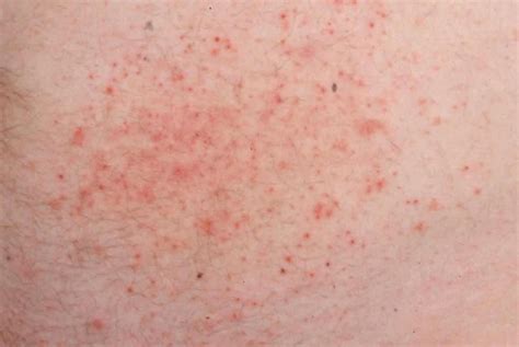 Dermatitis Herpetiformis Close Up Image Credit Ballenablanca 2013