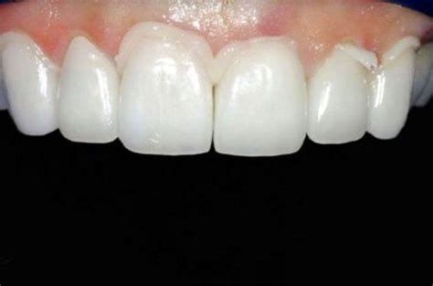Permanent Dental Cement For Caps Crown Bridges Inlays Teeth Diy Tooth