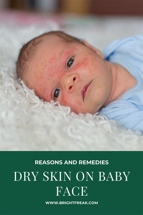 Dry Skin On Baby Face