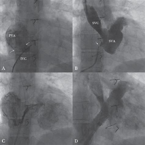Straight Ap Angiograms Demonstrating Inferior Venous Baffle Obstruction