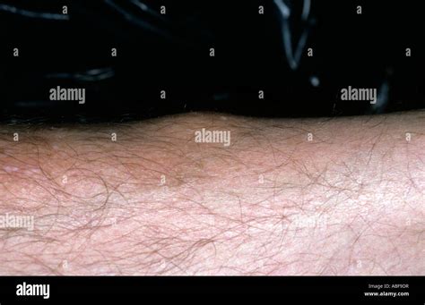 Nodule Disease Hi Res Stock Photography And Images Alamy