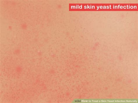 Skin Infections Bacterial Viral Fungal And Parasitic