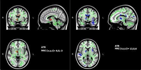 Figure 4 From Characteristics Of Brains In Autism Spectrum Disorder Structure Function And