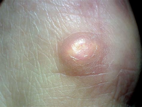 Boil Vs Cyst How To Identify Them
