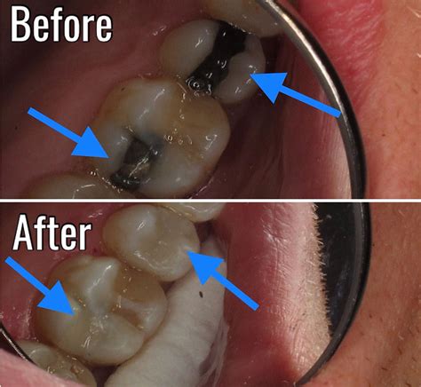 Should You Replace Old Amalgam Fillings With White Fillings
