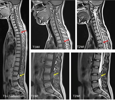 Two Spinal Lesions Schwannoma And Meningioma Radiology Cases