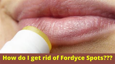 How To Treat Fordyce Spots On Lips At Home You