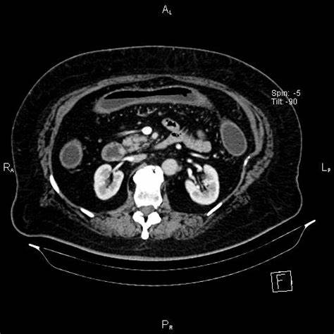 Язвенный колит неспецифический диета Неспецифический язвенный колит (ulcerative colitis) | Радиография Неспецифический язвенный колит (ulcerative colitis) | Радиография Язвенный колит неспецифический диета