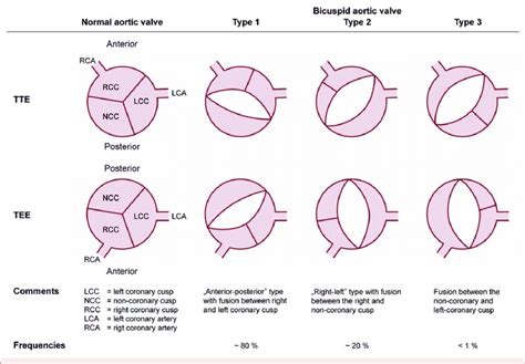 Anatomical Types Of Bicuspid Aortic Valve Bav According To A Classifi