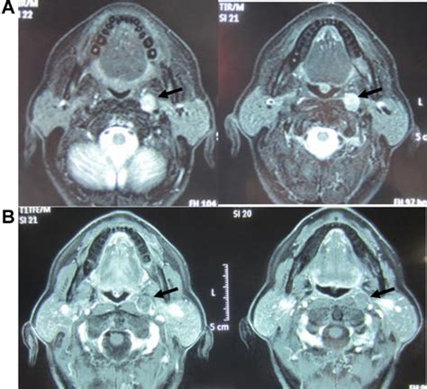 Mris Of A Recurrent Retropharyngeal Node From Hypopharyngeal Carcinoma