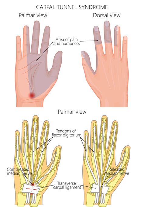 Carpal Tunnel Syndrome Perth Orthopaedic Specialist Centre