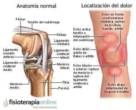 los patrones del dolor de rodilla o gonalgia y las lesiones mas comunes fisioterapia online