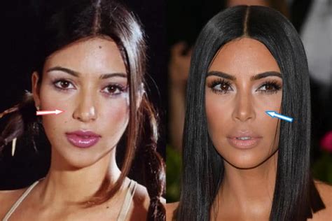 Kim Kardashian Plastic Surgery Revealed Before And After Pics 2018