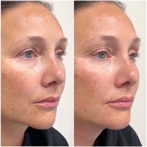 before and after facial reshaping dr harris clinic facebook