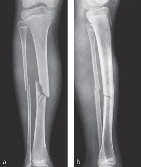 Tibia And Fibula Shaft Simple Fracture Oblique Musculoskeletal Key