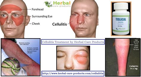 Cellulitis Face Treatment Doctor Heck