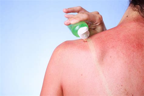 How Long Does A Sunburn Last Experts Explain