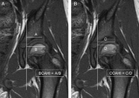 Magnetic Resonance Imaging Scans Of A Normal Left Hip Coronal