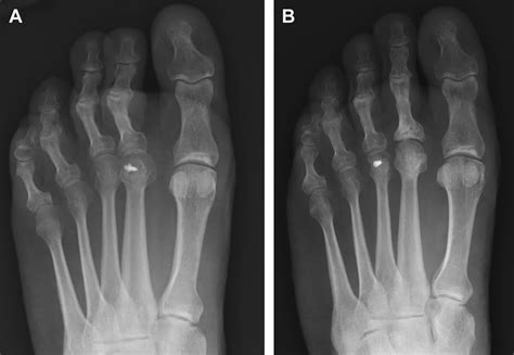 Managing Complications Of Lesser Toe And Metatarsophalangeal Joint