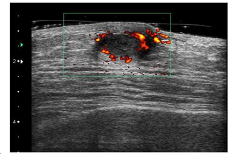 Ultrasonography Revealed A Hypoechoic Lesion 16 Mm In Size With