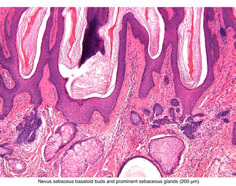 Pathology Outlines Nevus Sebaceus Of Jadassohn