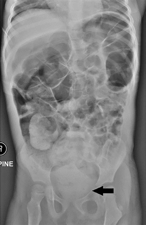 Abdominal Radiography Of A 3 Year Old Girl With A Chief Complaint Of