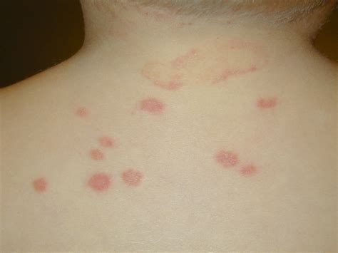 Ring 44 Ringworm Causes In Toddlers Png