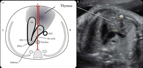 The Thymicthoracic Ratio In Fetal Heart Defects A Simple Way To