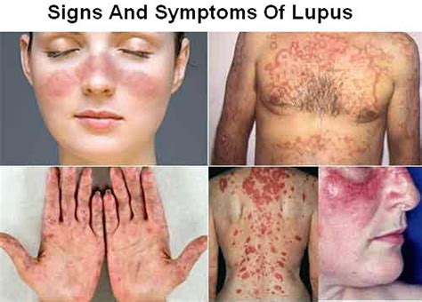 Lupus Systemic Lupus Erythematosus Sle Causes Sign And Symptoms