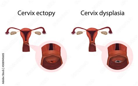 Cervix Ectopy And Dysplasia Cervical Disease Medical Anatomy