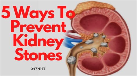 5 Ways To Prevent Kidney Stones What Keeps Kidney Stones Away
