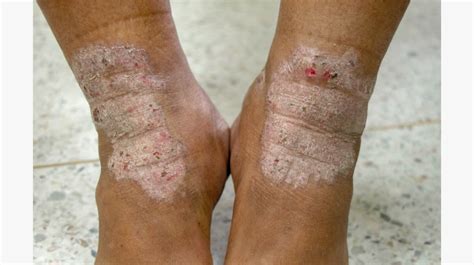 Atopic Eczema On Black Skin