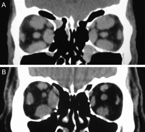 Coronal Ct Scans From Two Patients With Graves Orbitop Open I