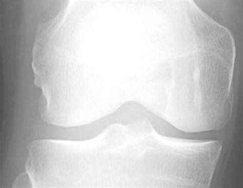 Defining Radiographic Incidence And Progression Of Knee Osteoarthritis