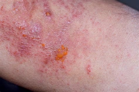 Fotografia Di Chiusura Estrema Dei Sintomi Di Dermatite Atopica