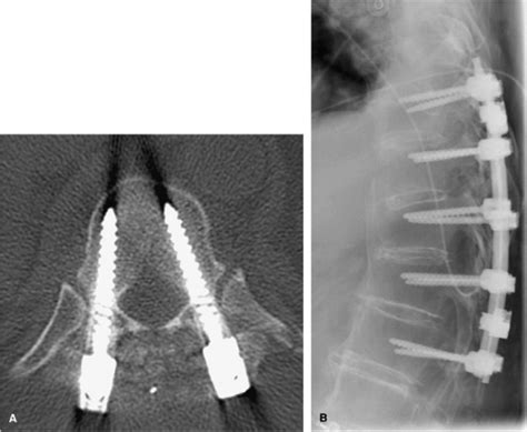Surgical Treatment Of Spinal Injury Neupsy Key