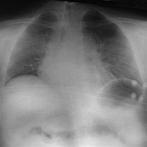 Chest X Ray In Anterior Posterior Projection The Diaphragm Was Highly