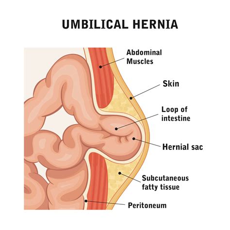 Hernia Umbilical Hernia QX
