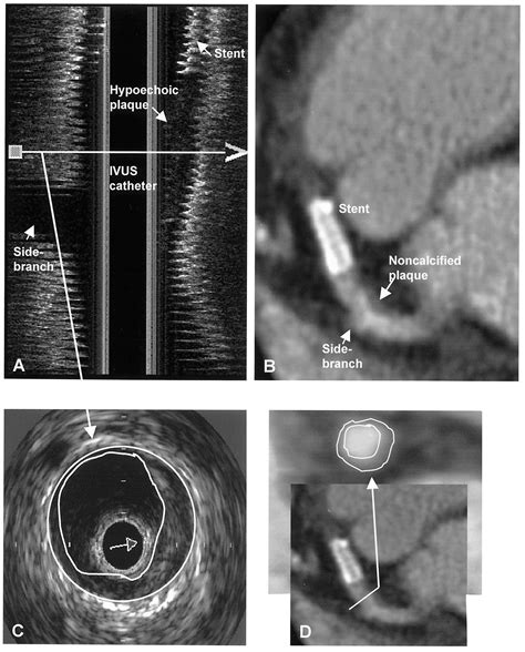 Accuracy Of Multidetector Spiral Computed Tomography In Identifying And