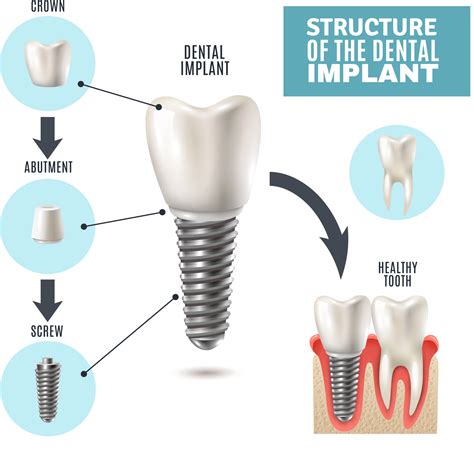 Dental Implants - White Teeth Dental Clinic @Rayong