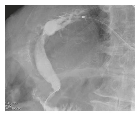 A Cholangiogram Showing Complete Clearance Of Stones From The Common