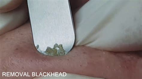 Popping Tons Of Blackheads Part 05 Youtube