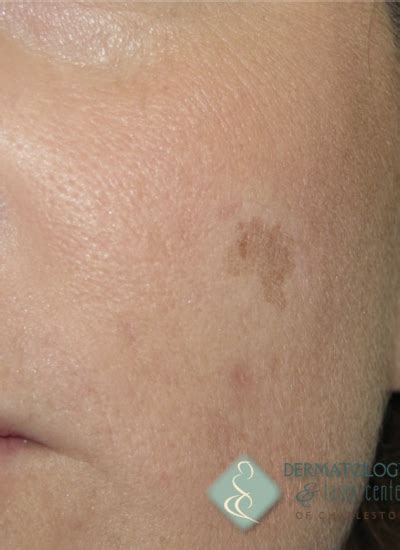 Photodynamic Therapy For Actinic Keratosis Dermatology And Laser Center